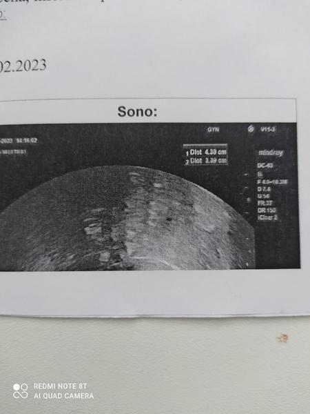 Černé tečky na ultrazvuku. Co znamenají?