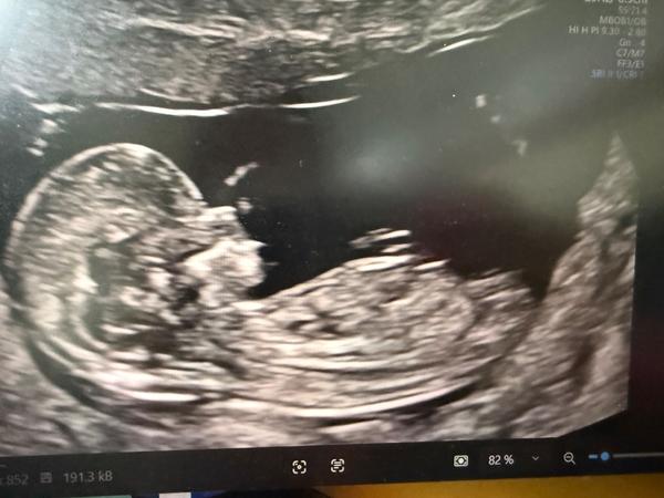 Pohlaví podle screeningu ve 12. týdnu. Co myslíte?