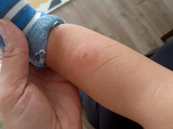 Poštípání od muchničky? Jak jste řešili?