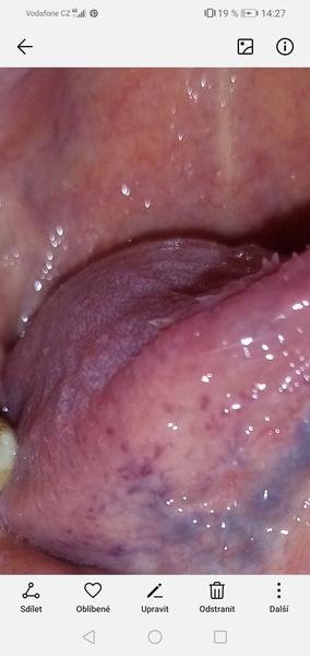 Malé fialové tečky pod jazykem. Máte s nimi zkušenost?