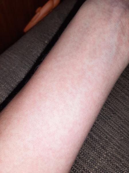 Příznaky páté nemoci u dospělého: Na co si dát pozor?