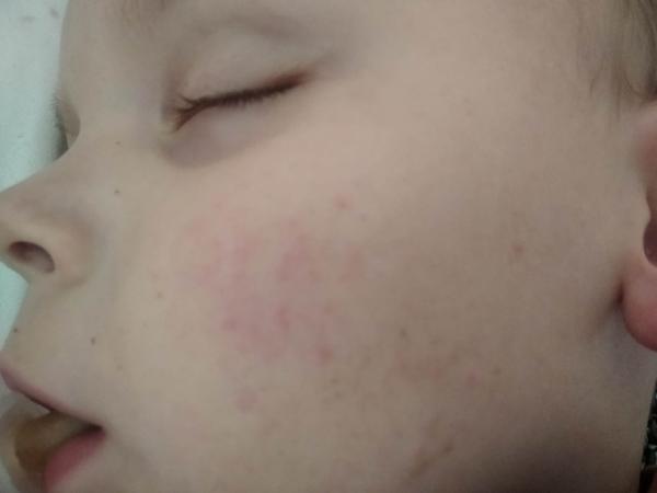 Pupínky na tvářích a na těle. Co by to mohlo být?