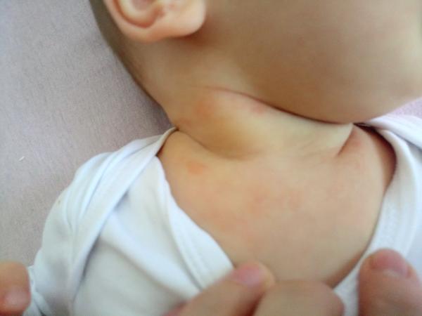 Poznáte prosím tuhle vyrážku?