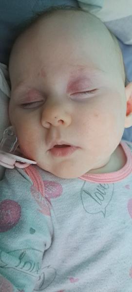 Červené fleky. Kvasinka nebo atopický ekzém?