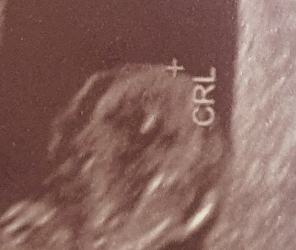 Ultrazvuk. Vidím obličej miminka?