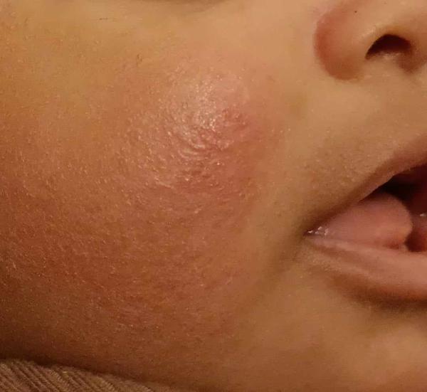 Zinková mast a vyrážka u miminka. Pomáhá opravdu?