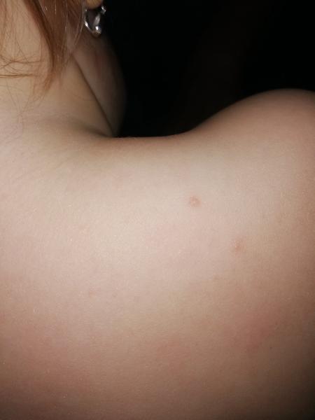 Pupínky u batolete, které nesvědí