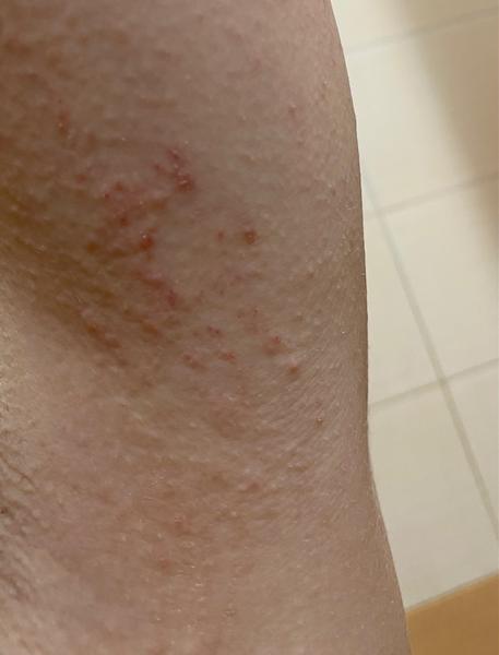 Je to ekzém nebo svrab? Rozpoznání a rady.