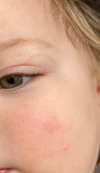 Poradíte, čím vyléčit "ekzém" pravděpodobně z mrazu?