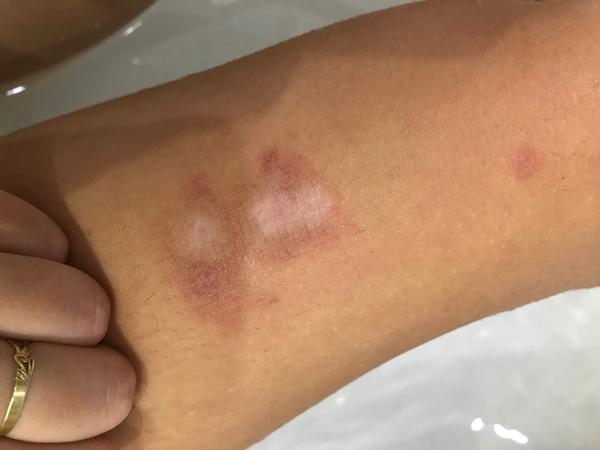 Kožní problém. Co to může být? Mizí to?