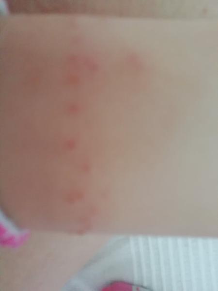 Jsou tohle neštovice?