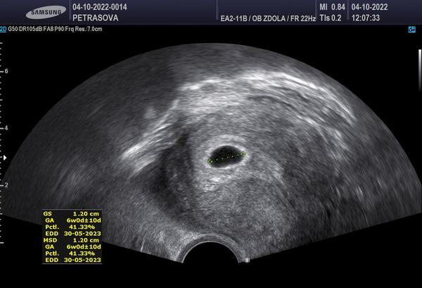 Je normální nevidět srdíčko v 6. týdnu těhotenství?
