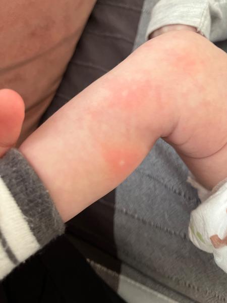 Navržený titulek:
Vyrážka nebo štípanec? Jak poznat příčinu flíčků u dítěte?