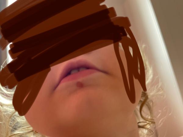 Jak rozpoznat opar a jak jej léčit?