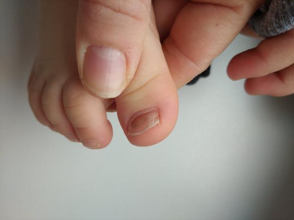 Hnědý flek pod nehtem. Co by to mohlo být?