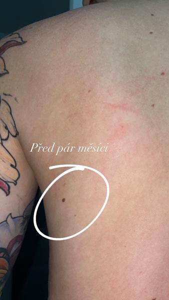 Strach ze změn u znaménka na zádech. Co teď dělat?