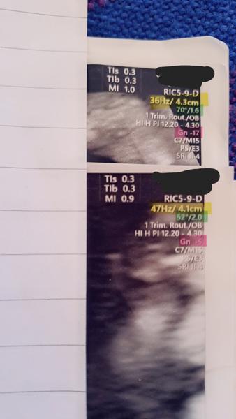 Zaznamenává ultrazvuk srdeční akci plodu?