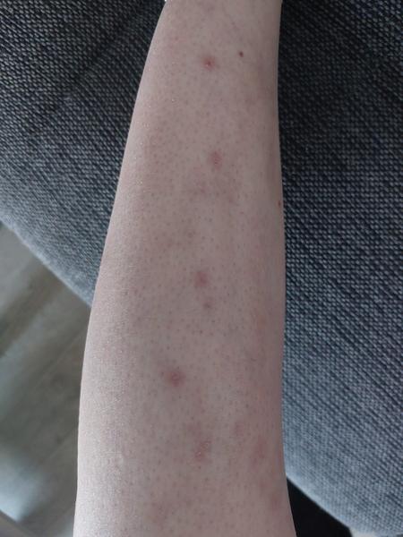 Jak se zbavit pupínků a jizev po nich?