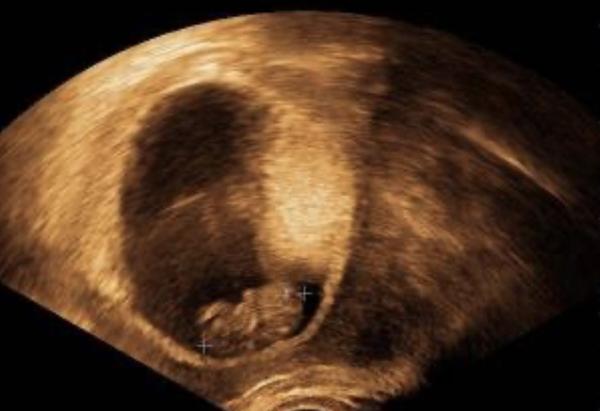 Těhotenství a krvácení. Je to důvod k obavám?