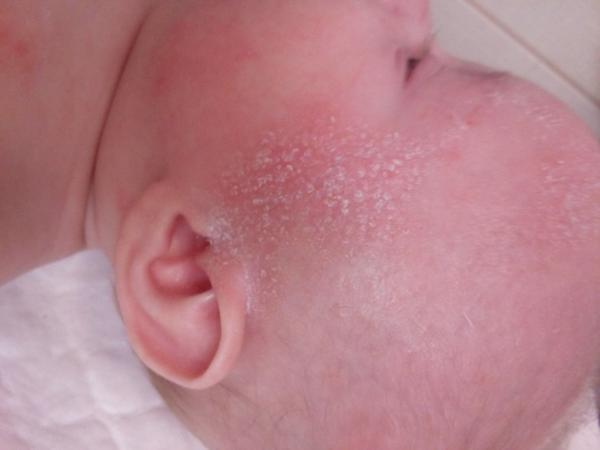 Ekzém u 4měsíčního miminka. Poradíte, prosím?