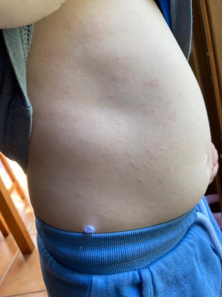 Zkušenosti s pupínky u dítěte. Co by mohlo pomoci?