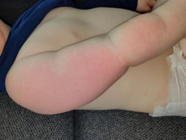 Pátá nemoc bez teploty u dítěte. Možné zkušenosti?