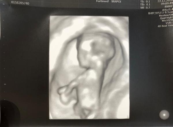 Kluk nebo jen pupeční šnůra?