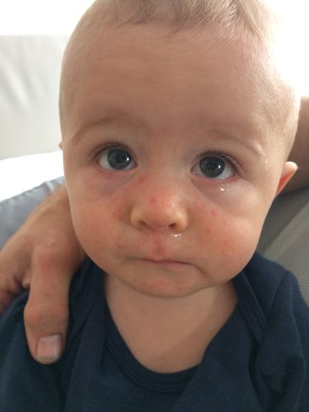 Pupínky v obličeji a za ouškama