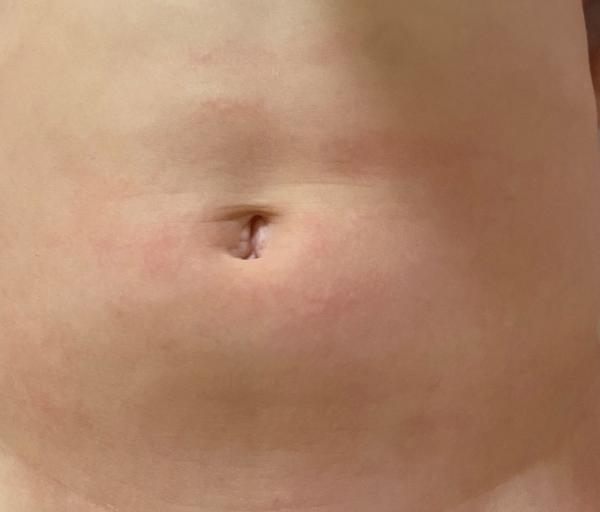 Je to atopický ekzém, nebo něco jiného? Zkušenosti rodičů