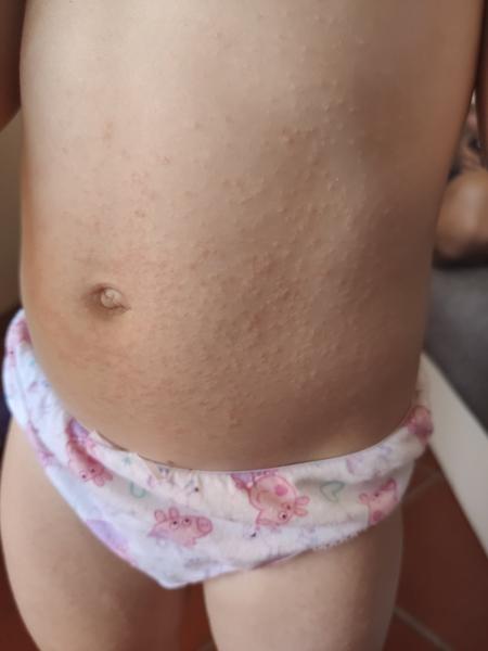 Ekzém? Jak prosím postupovat?