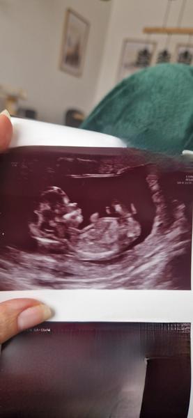 Podle ultrazvuku ve 14. týdnu těhotenství. Kluk nebo holka?