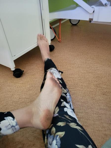 Co dělat, když na hlavě zůstává dlouhotrvající modřina?