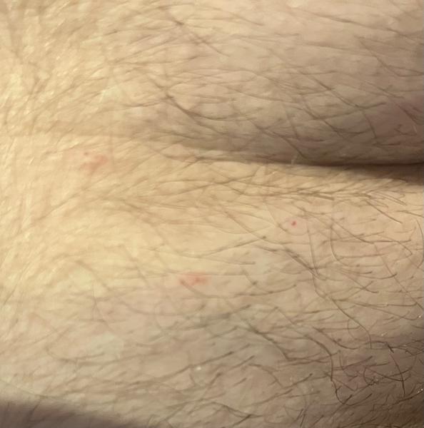 Svědění a pupínky po těle. Může to být svrab?