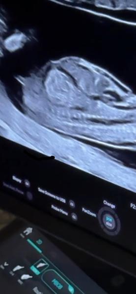 Pohlaví miminka. Jaké je?