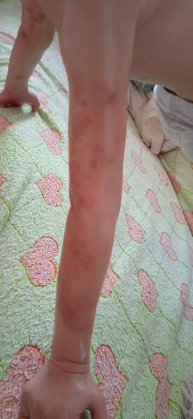 Ekzém nebo kvasinka?