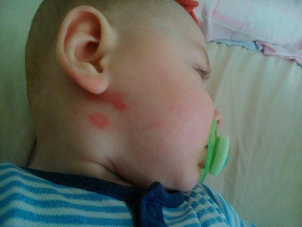 Zimní ekzém? Co vám pomohlo?