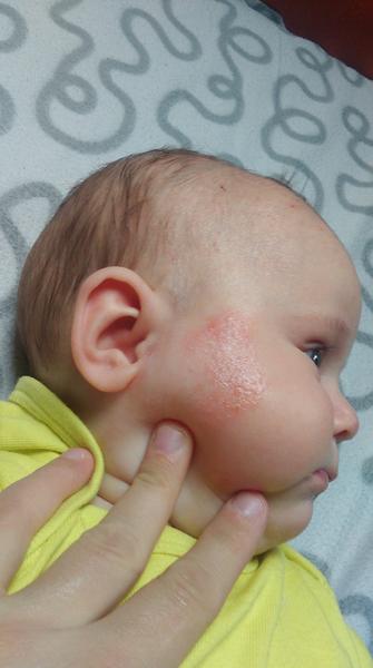 Dětská dermatitida. Co udělat, aby se nevracela?