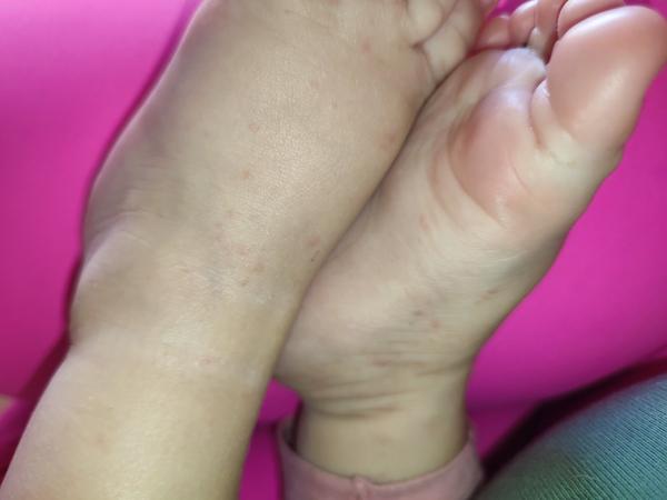 Vyrážka. O co by se mohlo jednat?