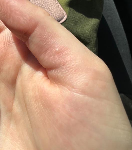 Svědivé puchýřky na těle. Je to svrab nebo alergie?