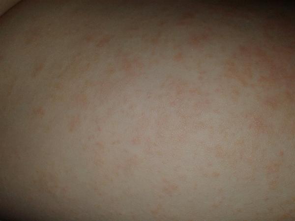 Vyrážka-týden. Co myslíte?