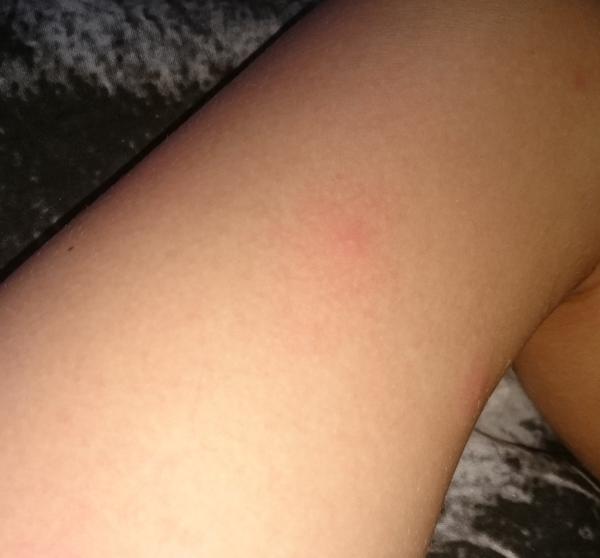 Záhadné pupínky. Co by to mohlo být?