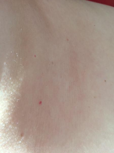 Červená znaménka mezi prsy a nad pupíkem. Je to normální?