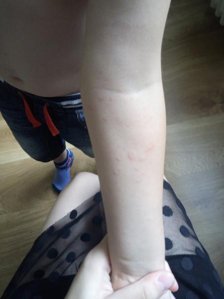 Mohou to být pupínky ze slunce?