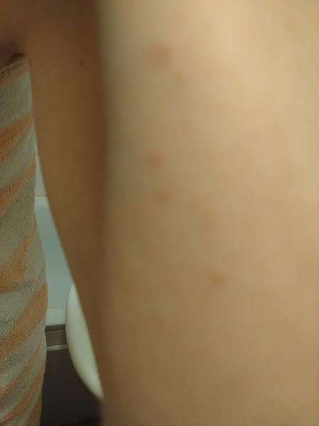 Pupínky na zápěstí. Je to alergie nebo svrab?