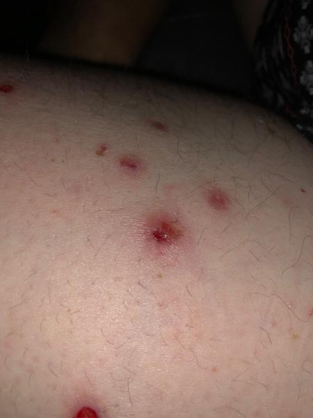 Příčiny červených pupínků na stehnech. Co je způsobuje?