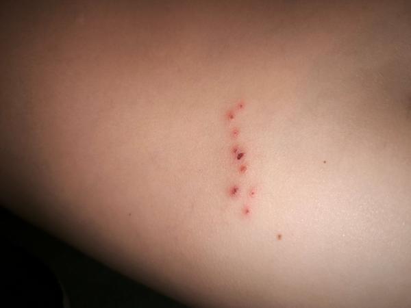 Štípance na zádech u dítěte po škole. Co to může být?