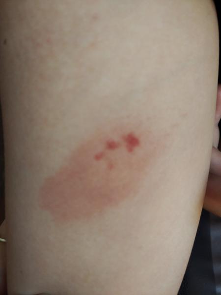 Co může způsobit vyrážku na ruce u dítěte?