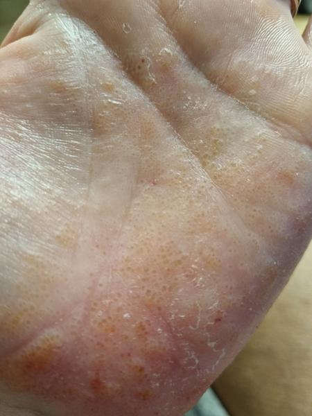 Vyrážka na dlaních: Proč kortikoidní masti nezabírají?