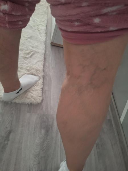 Problémy s křečovými žilami v těhotenství a jak je řešit?