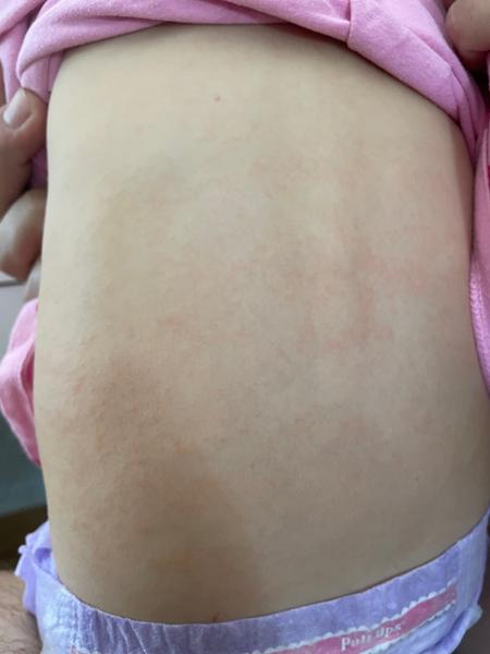 Kopřivka u malého dítěte: Může teplota naznačovat něco vážnějšího?